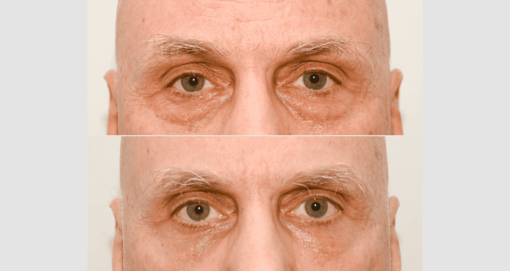 Nahaufnahme eines Mannes mit Hautveränderungen vor und nach der Behandlung.