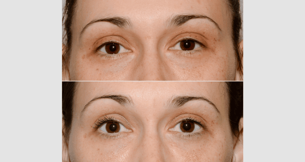 Vorher-Nachher Vergleich der Hautpflege bei Augenpartie.