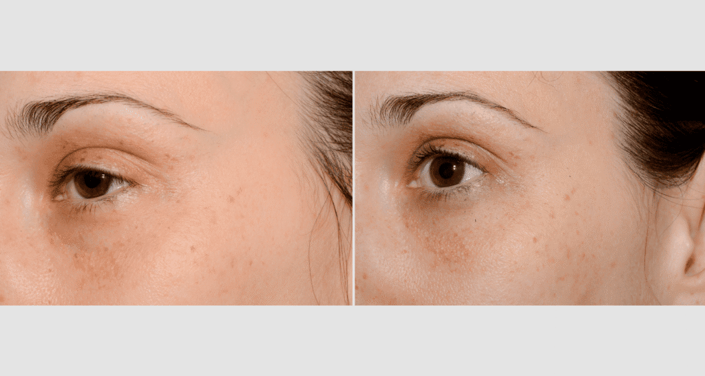 Vorher-Nachher Vergleich der Hautaufhellung und Hautverjüngung.