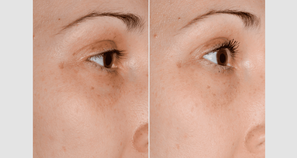 Vorher-Nachher Vergleich der Hautreinigung und -pflege.