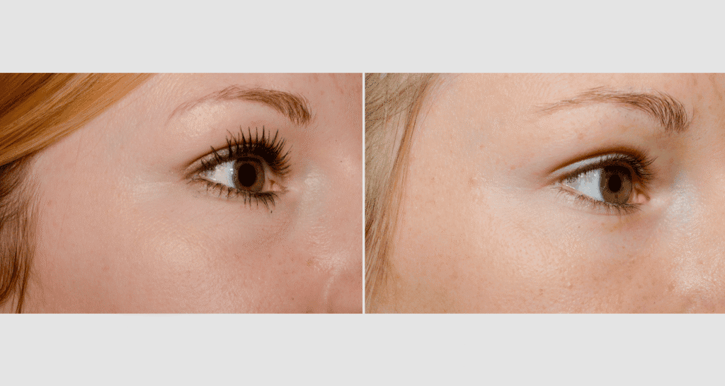 Vergleich von Haut vor und nach der Hautpflegebehandlung.
