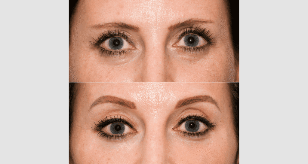 Nahaufnahme eines Gesichts vor und nach Hautbehandlung, Fokus auf Hautverbesserung.