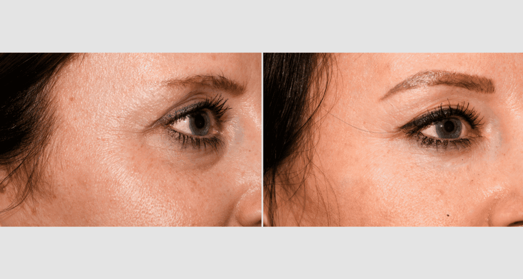 Vorher-Nachher Vergleich der Hautverjüngung bei Frau mit Hautproblemen.