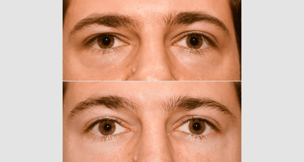 Nahaufnahme von Hautveränderungen im Gesicht, Vorher-Nachher-Bild.