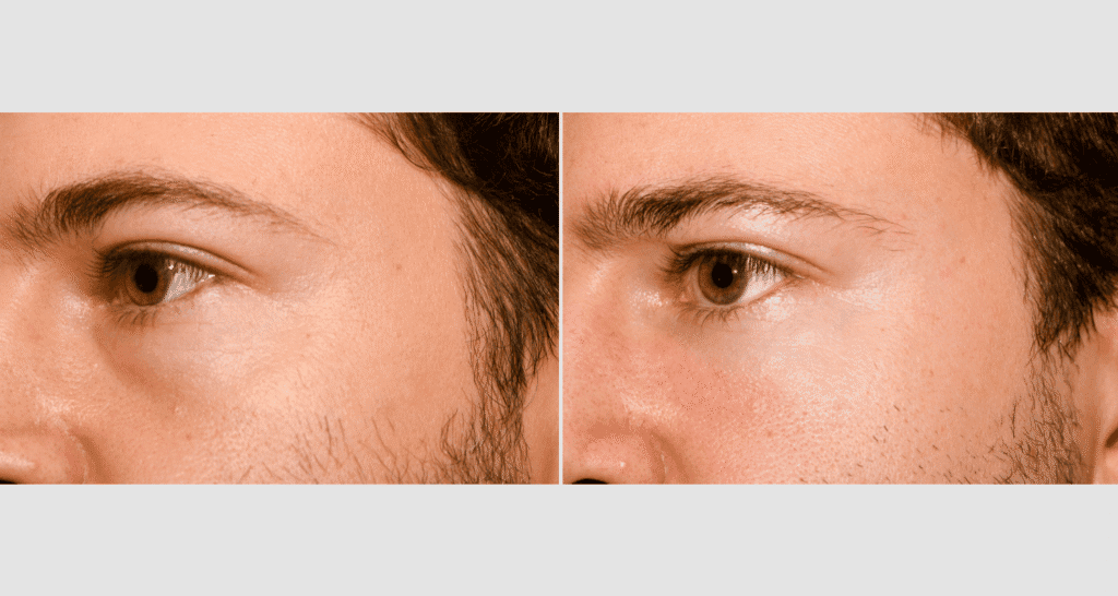 Vergleich von Männerhaut vor und nach Hautpflege, Gesichtspflege, Hautverbesserung.