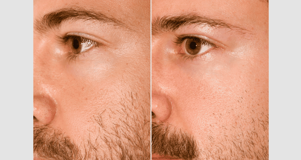 Nahaufnahme eines Mannes mit Hautveränderungen vor und nach Rasur.