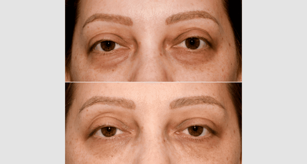 Vergleich der Haut vor und nach einer kosmetischen Behandlung, sichtbare Verbesserungen.