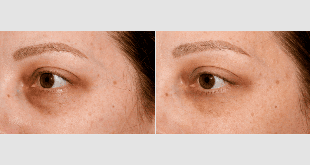 Vergleich von Haut vor und nach Behandlung gegen Akne und Pigmentflecken.