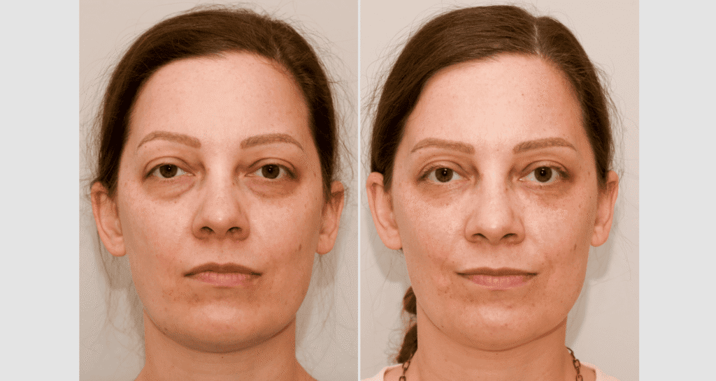 Vorher-Nachher Bild einer Frau mit Hautverbesserung.