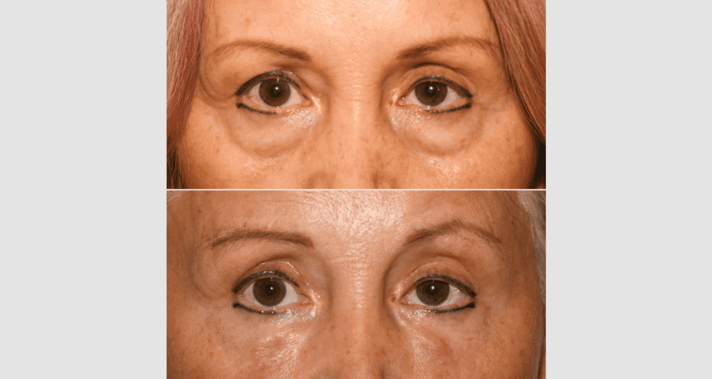 Vorher/Nachher Ergebnis: Unterlidstraffung Korrektur Traenensaecke Augenringe Mini Midfacelift