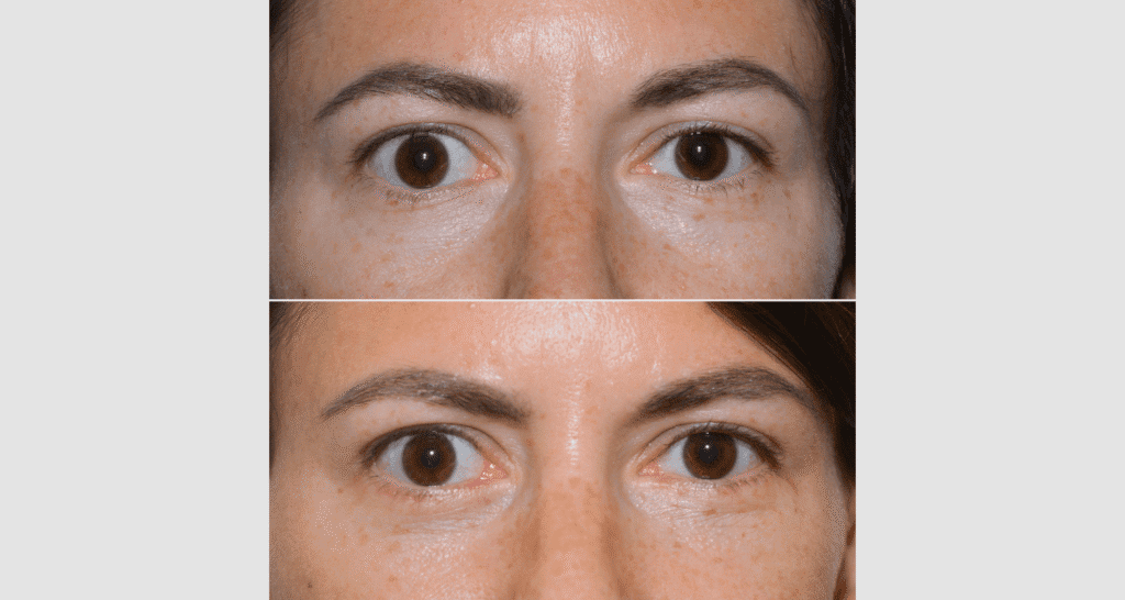 Vorher/Nachher Ergebnis: Unterlidstraffung Korrektur Traenensaecke Augenringe Mini Midfacelift