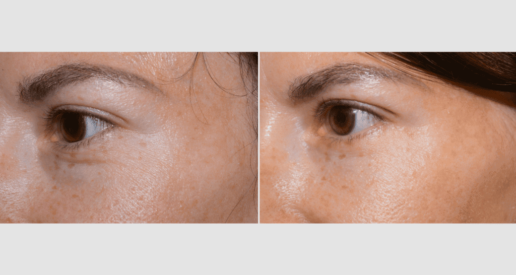 Vorher/Nachher Ergebnis: Unterlidstraffung Korrektur Traenensaecke Augenringe Mini Midfacelift