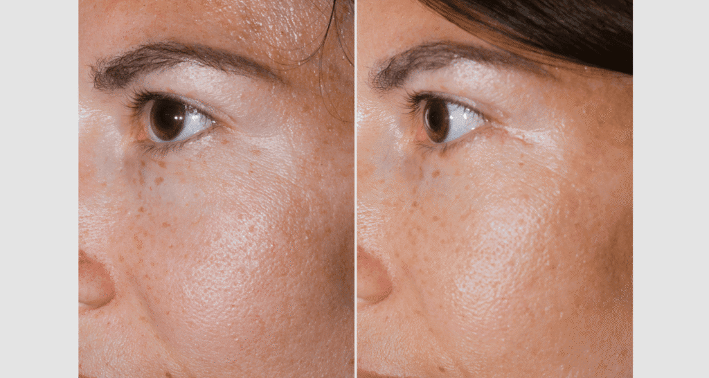 Vorher/Nachher Ergebnis: Unterlidstraffung Korrektur Traenensaecke Augenringe Mini Midfacelift