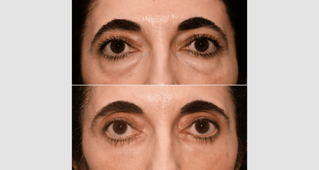 Vorher/Nachher Ergebnis: Unterlidstraffung Korrektur Traenensaecke Augenringe Mini Midfacelift