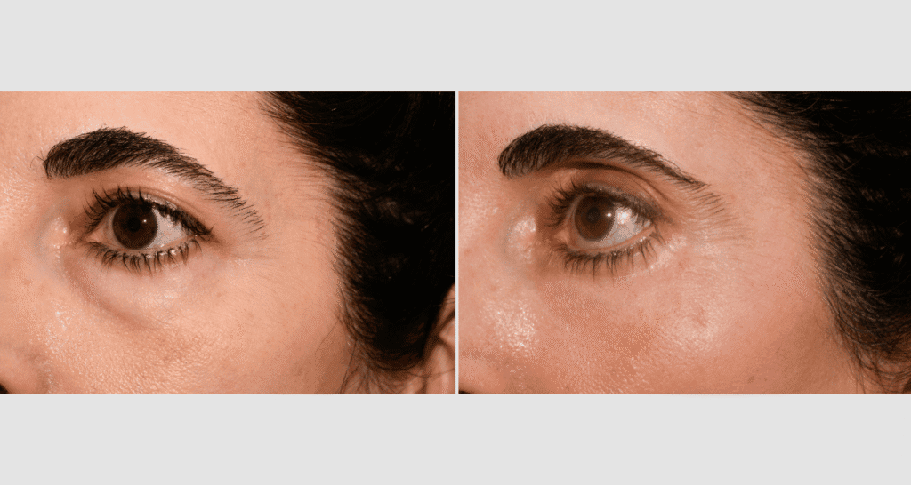 Vorher/Nachher Ergebnis: Unterlidstraffung Korrektur Traenensaecke Augenringe Mini Midfacelift