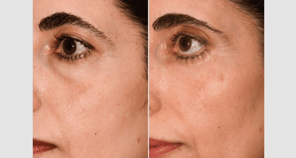 Vorher/Nachher Ergebnis: Unterlidstraffung Korrektur Traenensaecke Augenringe Mini Midfacelift