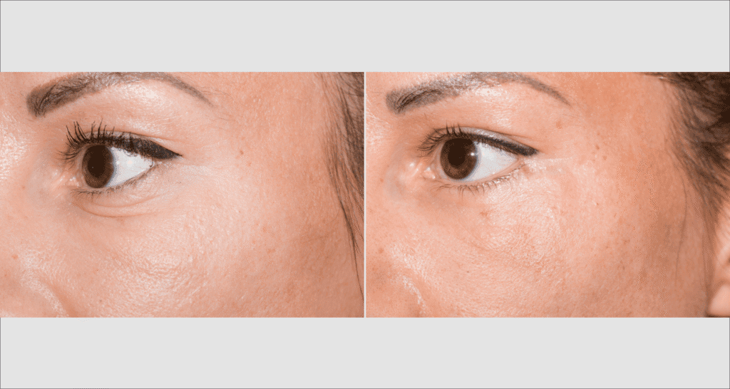 Vorher/Nachher Ergebnis: Unterlidstraffung Korrektur Traenensaecke Augenringe Mini Midfacelift