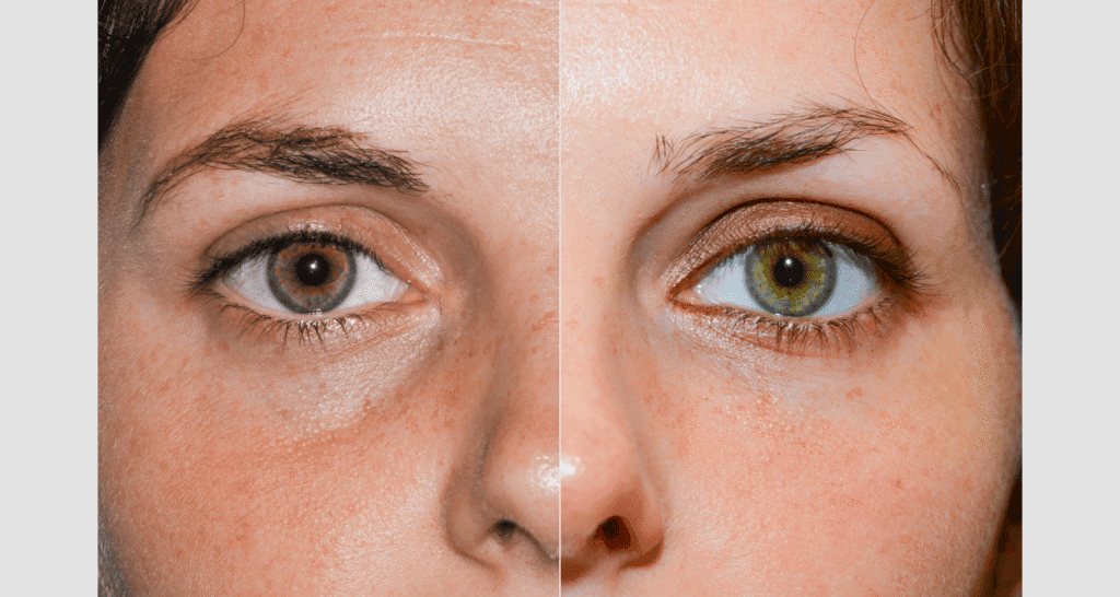 Vorher/Nachher Ergebnis: Unterlidstraffung Korrektur Traenensaecke Augenringe Mini Midfacelift