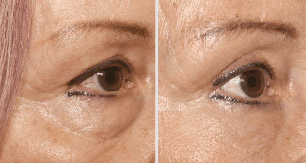 Vorher/Nachher Ergebnis: Unterlidstraffung Korrektur Traenensaecke Augenringe Mini Midfacelift