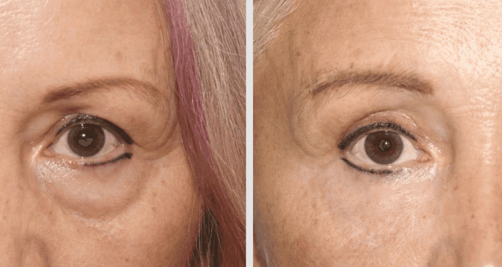 Vorher/Nachher Ergebnis: Unterlidstraffung Korrektur Traenensaecke Augenringe Mini Midfacelift