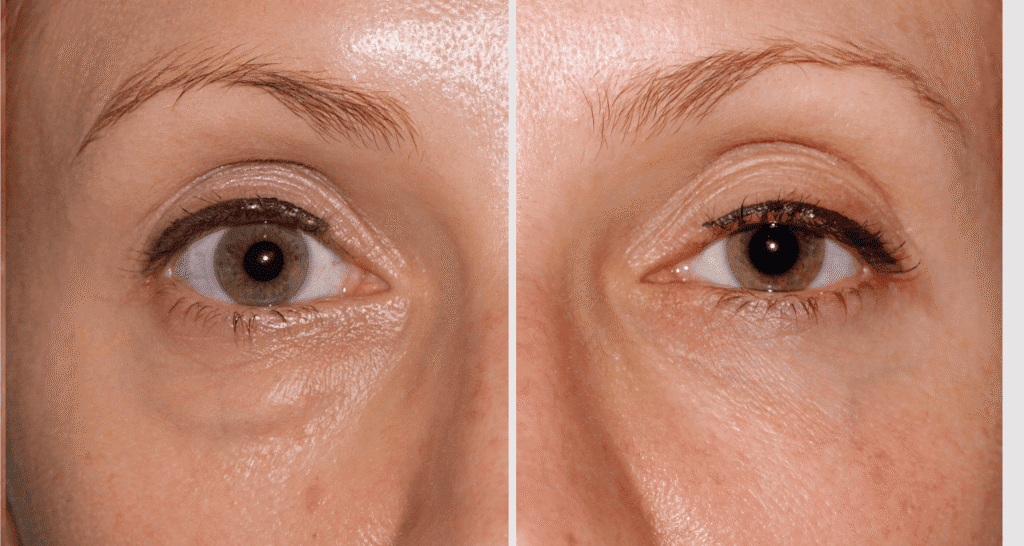 Vorher/Nachher Ergebnis: Unterlidstraffung Korrektur Traenensaecke Augenringe Mini Midfacelift