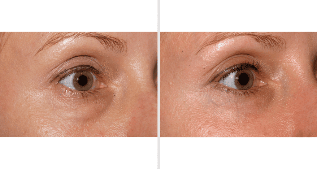 Vorher/Nachher Ergebnis: Unterlidstraffung Korrektur Traenensaecke Augenringe Mini Midfacelift