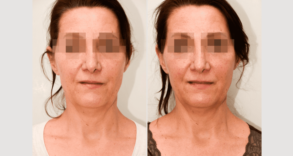 Vorher/Nachher Ergebnis: Vampire Lift