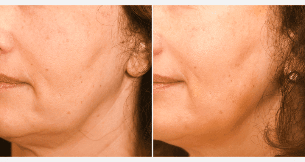 Vorher/Nachher Ergebnis: Vampire Lift