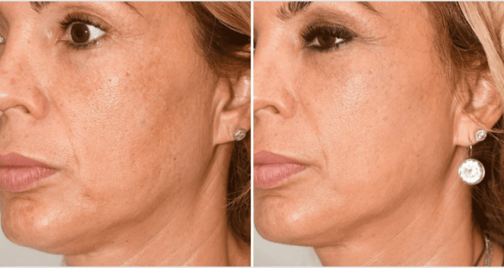 Vorher/Nachher Ergebnis: Vampire Lift