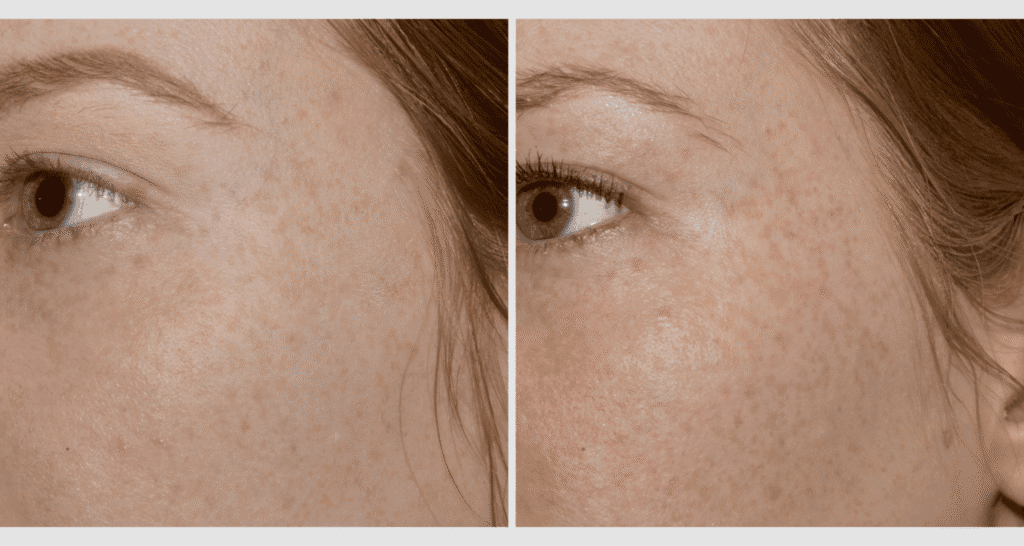 Vorher/Nachher Ergebnis: Vampire Lift