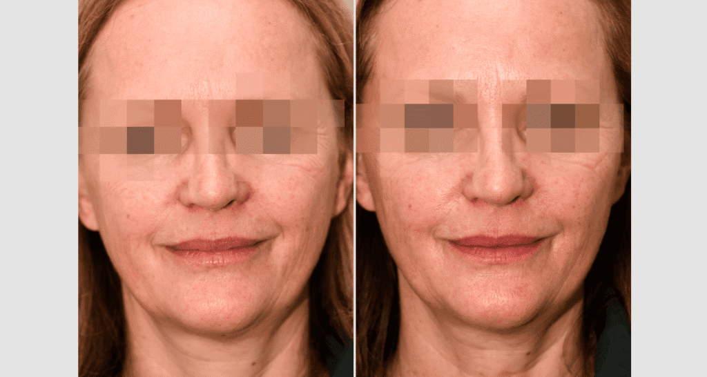 Vorher/Nachher Ergebnis: Vampire Lift