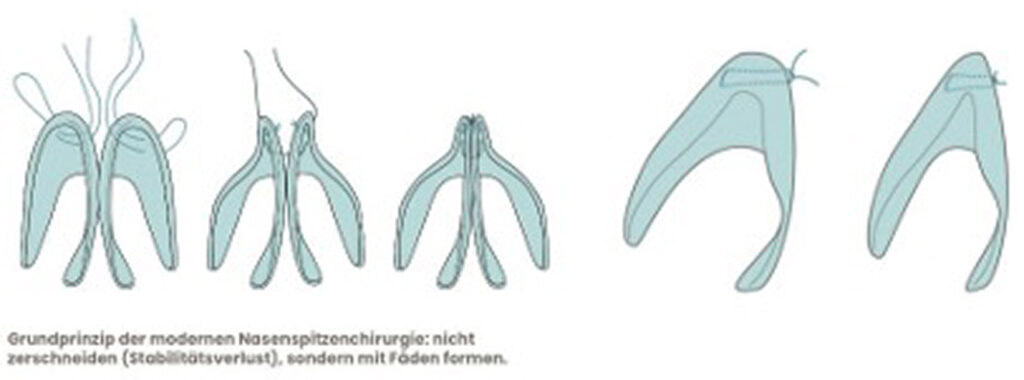 Frau nach Nasenkorrektur im Beratungsgespräch, plastische Chirurgie.