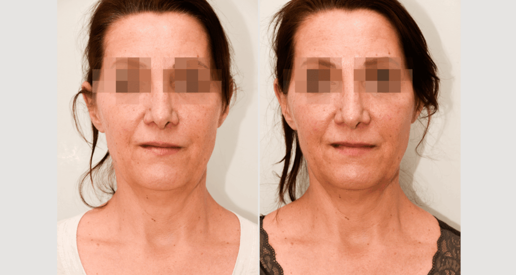 vorher-nachher-vampire-lift-1