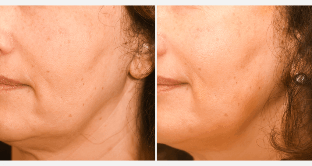 vorher-nachher-vampire-lift-2