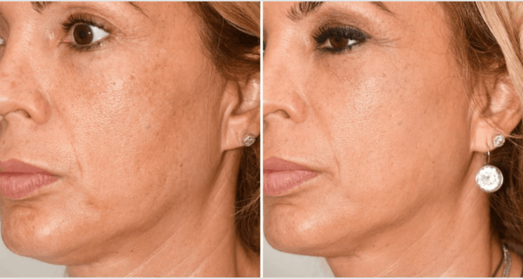 vorher-nachher-vampire-lift-3