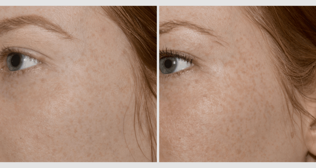 vorher-nachher-vampire-lift-4