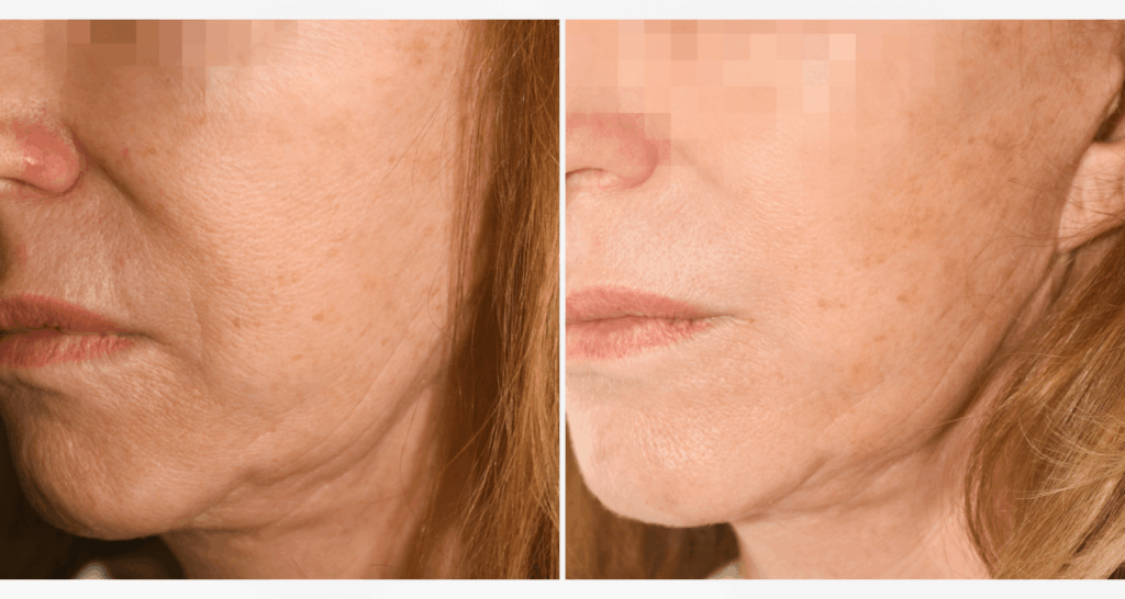 vorher-nachher-vampire-lift-5