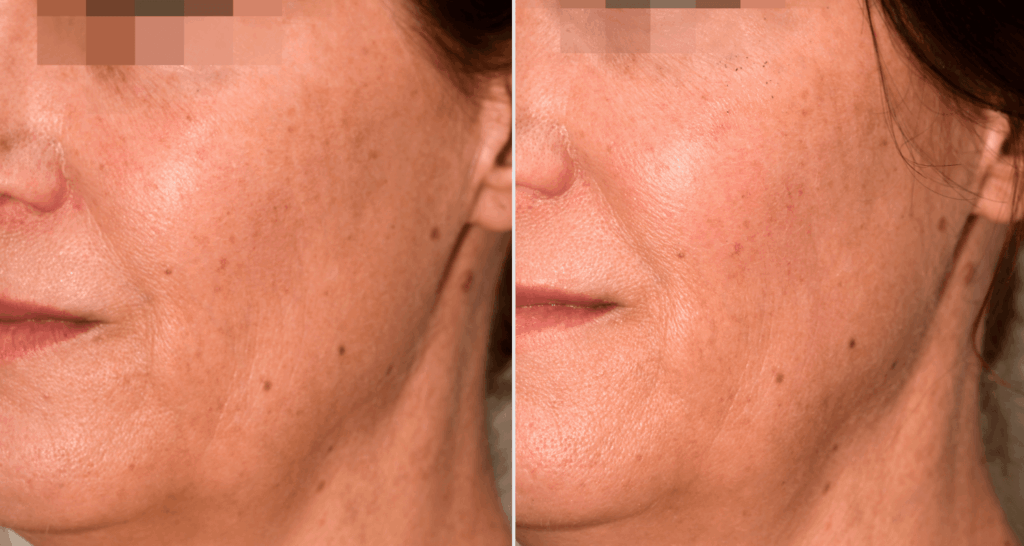 vorher-nachher-vampire-lift-6