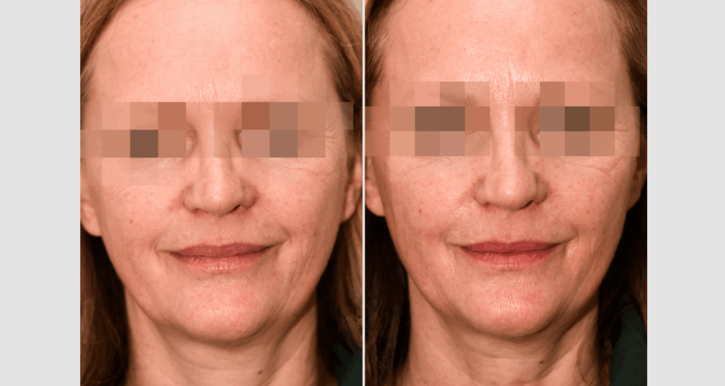 vorher-nachher-vampire-lift-8